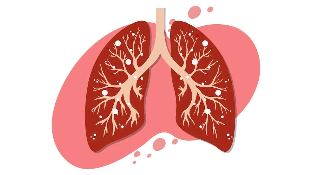 Can Popcorn Cause Lung Disease? Know About Symptoms Of Popcorn Popcorn Lung Disease OnlyMyHealth